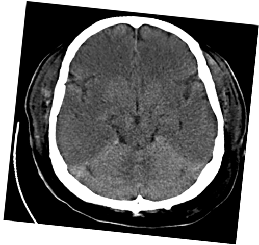 Anoxic Brain Injury