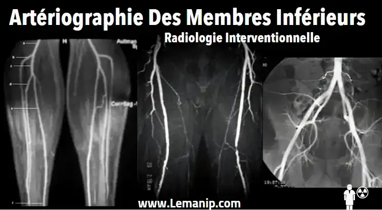 Artériographie Des Membres Inférieurs