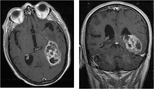 abnormal mri brain