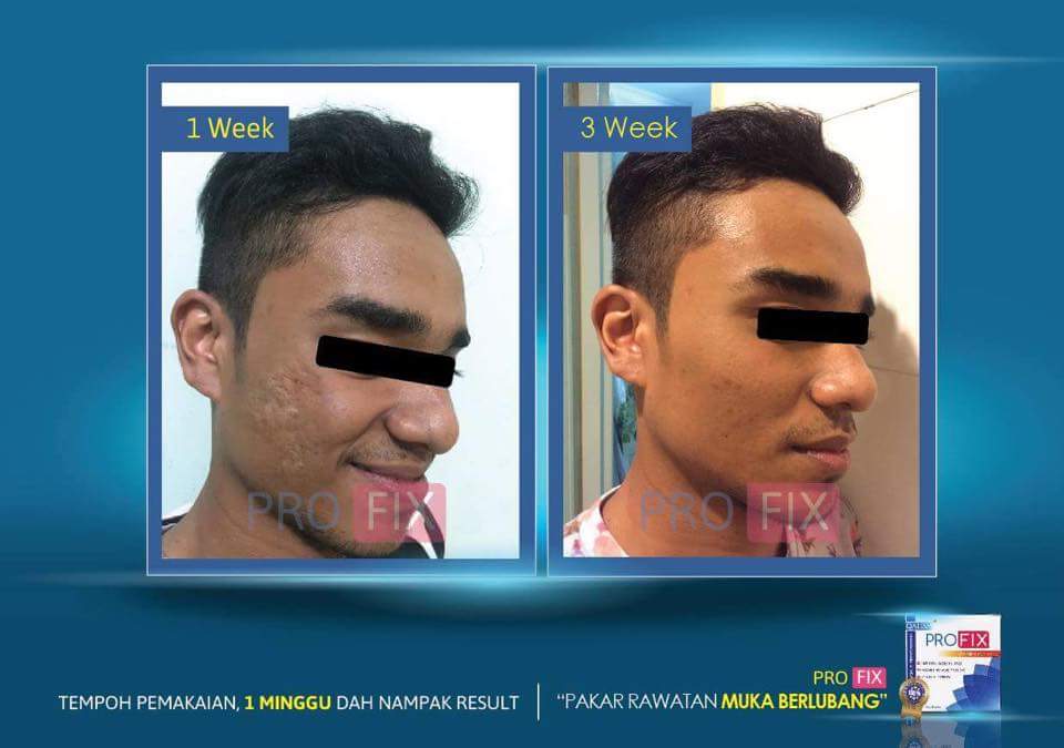 TUAN SABUN: UBAT MUKA BERLUBANG