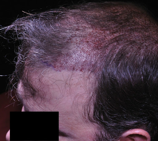 hair-transplant-charlotte-6.jpg