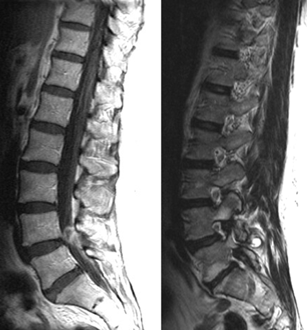 Synovial Cyst of the Lumbar Spine