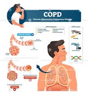 COPD (Chronic obstructive pulmonary disease) 