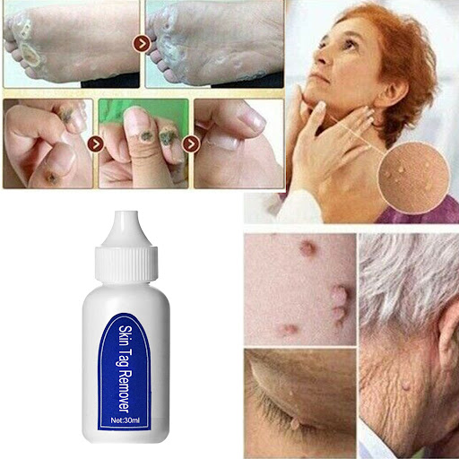Title 3, 10ml Instant Topical Skin Tag and Wart Remover....