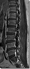 MRI LUMBAR SAGITAL