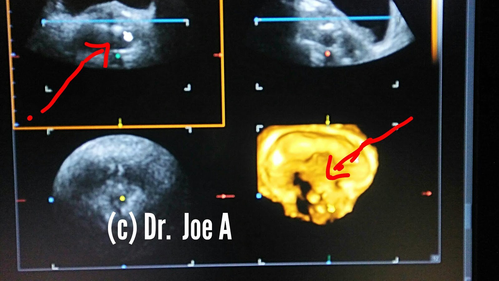 Ultrasound imaging: Prostate calculi 3D ultrasound