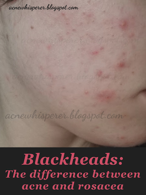 Are you sure it's adult acne?  Are you sure it's rosacea?  The difference is blackheads!  Find out more on the AcneWhisperer Blog.