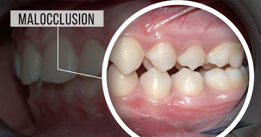 What is a problem with malocclusion?