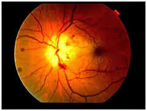 retina%2B8 Mirtoplus Obat Mata Terbaik Untuk Retinal Detachment