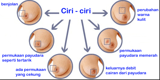 Hasil gambar untuk kanker payudara stadium 1