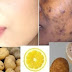 Remove BLACK SPOTS, DARK SPOTS & ACNE SCARS On Face, ONLY In 5 Days