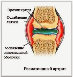 Почему болят суставы рук и ног