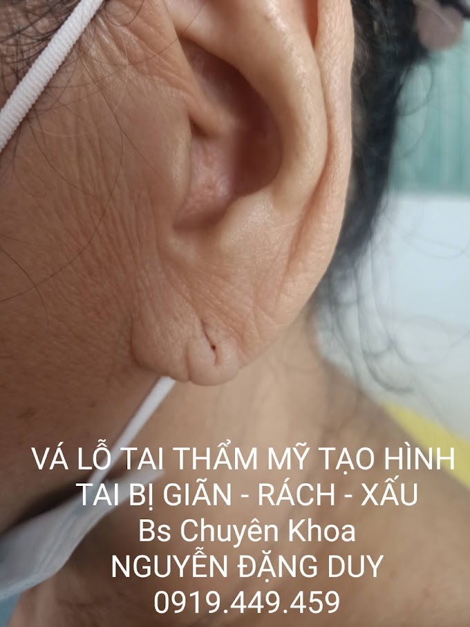 Vá lỗ tai Cà Mau | Vá tai Cà Mau | Vá lỗ tai giãn rộng do đeo bông Cà Mau | Vá tai giãn rộng do đeo bông Cà Mau | Vá lỗ tai thẩm mỹ Cà Mau | Mỹ Viện Nano Cà Mau | Phòng Khám Chuyên Khoa Kỹ Thuật Cao IMedic.vn | Bs chuyên khoa NGUYỄN ĐẶNG DUY 0919449459