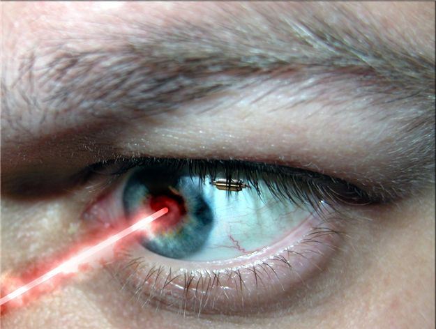 LASER CORRECTION OF VISION