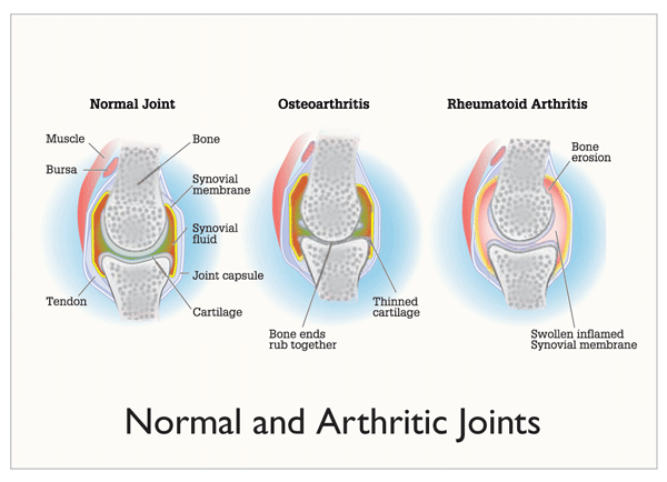 Gout-OrthoInfo - AAOS