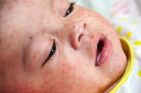 Measles Outbreak in Manipur Kills Two Children