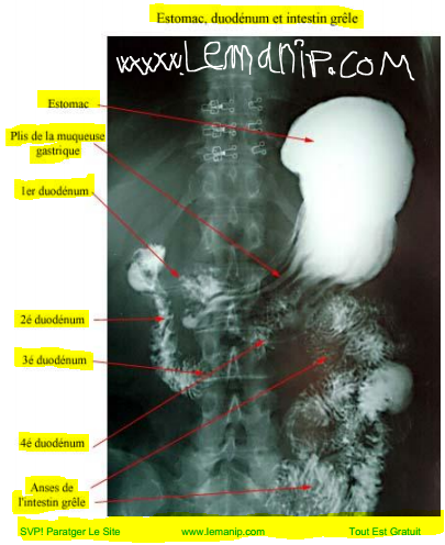 eosinophilic esophagitis symptoms in adults,ee esophagus,esophagitis endoscopy,the gastro group,dr rubin gastro,dr gold gastro,vanguard gastro,gj gastro,duodenal neuroendocrine tumor,esophageal esophagitis