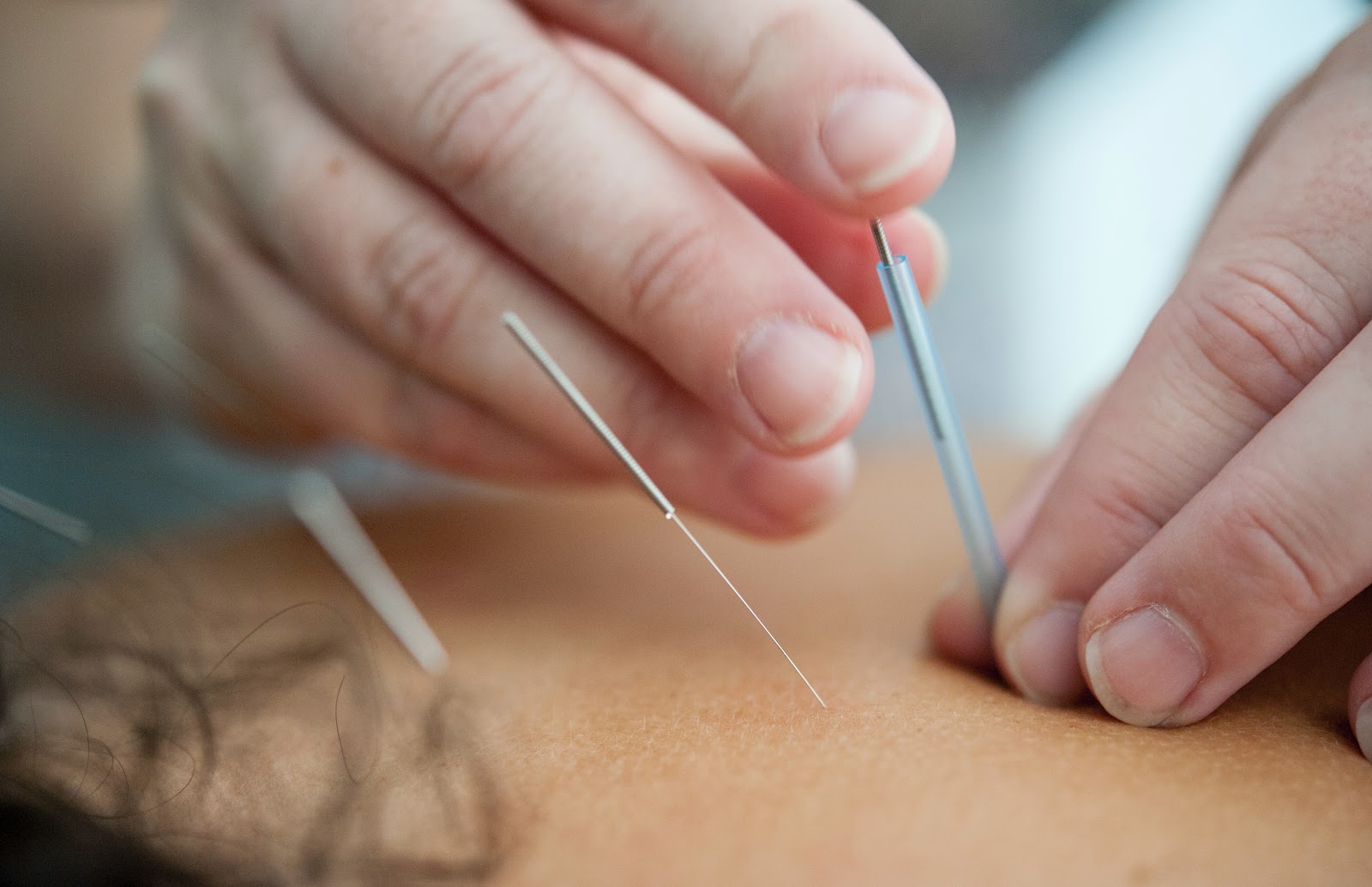 acupuncture for lower back pain