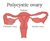 How to cure pcos naturally and get pregnant