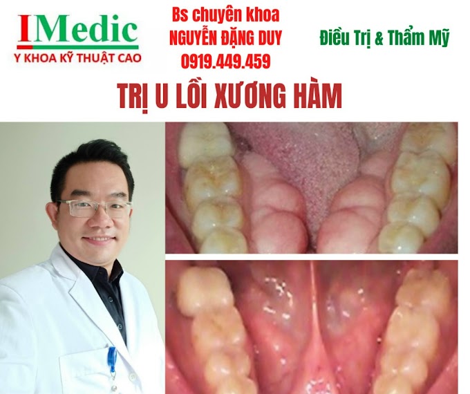 Trị khối u lồi sưng trong xương hàm Cà mau Trị tourus xương hàm Cà Mau Trị viêm khớp hàm khó há ngậm Cà mau Thế giới nha khoa Phòng khám chuyên khoa Kỹ Thuật Cao IMedic Y Khoa Kỹ Thuật Cao Phẫu thuật thẩm mỹ Cà mau Sài Gòn Bs chuyên khoa NGUYỄN ĐẶNG DUY 0919449459