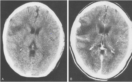 abnormal mri brain