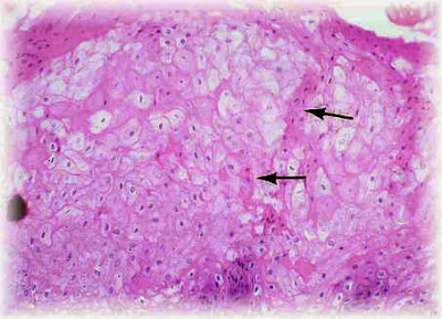 microscler telangiocectasius i varicoza intradermica