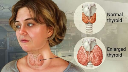 How To Get Rid Of Goiter Dreamopportunity25