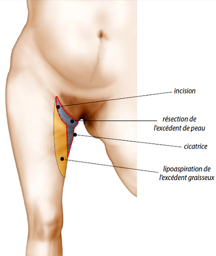 cicatrice lifting des cuisses