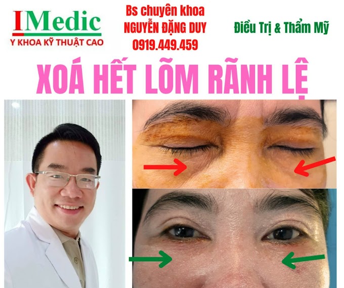 Xóa rãnh lệ Cà mau Trị rãnh lệ lõm mí mắt dưới da dư mỡ thừa mi mắt Cà mau Mỹ viện Nano Phòng khám chuyên Kỹ Thuật Cao IMedic Y Khoa Kỹ Thuật Cao Phẫu thuật thẩm mỹ Cà Mau Sài Gòn Bs chuyên khoa NGUYỄN ĐẶNG DUY 0919449459