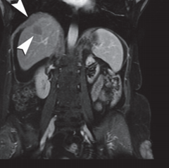 diagnos of mesothelioma