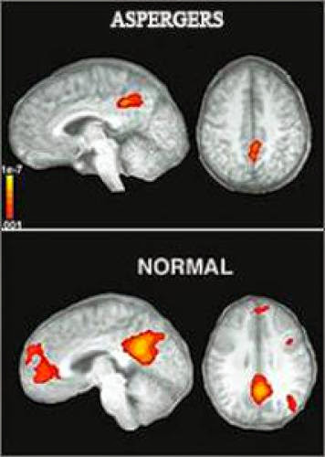 Neuroscience Sheds Light On Why People With Aspergers Syndrome Lack Empathy