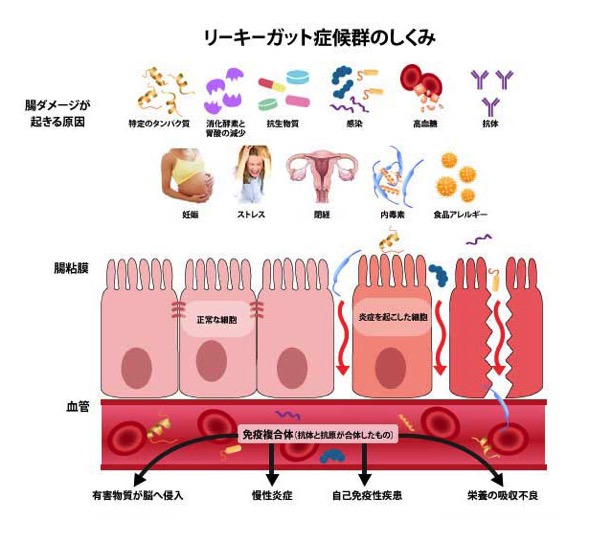 LeakyGut