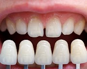 Tips Of Maintaining And Caring For Crowns And Bridges 