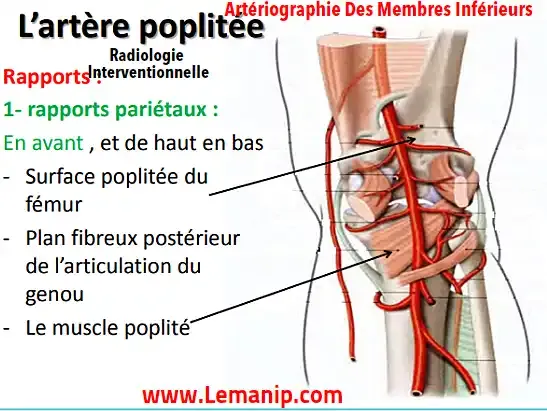 Définition d'une artériographie des membres inférieurs