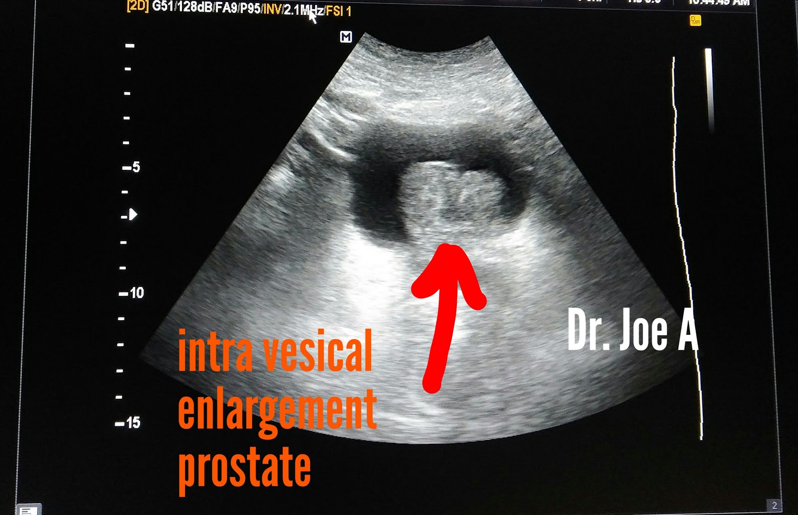 median lobe of prostate ultrasound