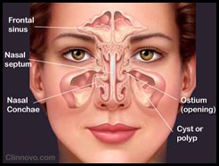 Sinusitis 02