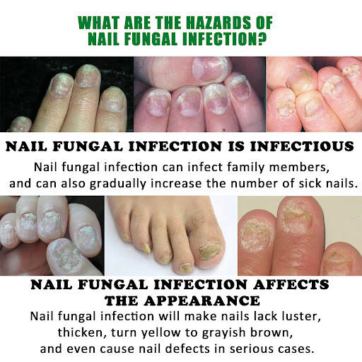 Title 4, Ginger Nail Care Solution for Soft Nails. Stren...