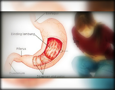 Gejala Awal Maag Kronis Dan Penanggulangan Awalnya