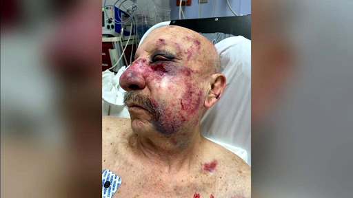 Family of elderly man attacked on Metromover suing Miami-Dade and AlliedUniversal Security