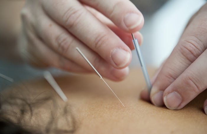 What To Wear To Acupuncture