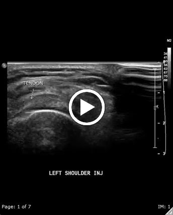 Shoulder injection steroid dose