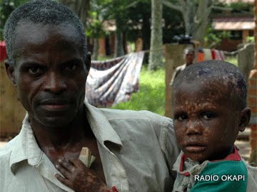 Professor Michel Equalanga: “Deaths from monkeypox are an unnecessary death that the country can avoid”