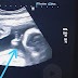 Bebê fez 'sinal de vitória' durante ultrassom, e pai com câncer ver isso como sinal divino.