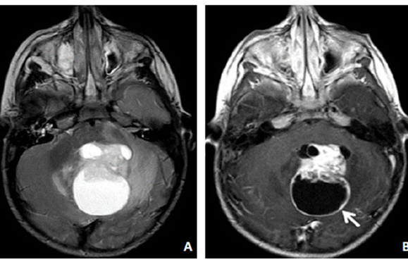 abnormal mri brain