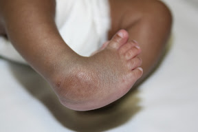 baby with clubfoot