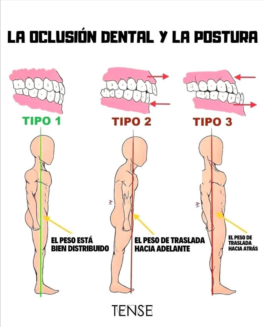 ☝️📸LA RELACIÓN ENTRE LA OCLUSIÓN DENTAL Y POSTURA CORPORAL‼️🤯