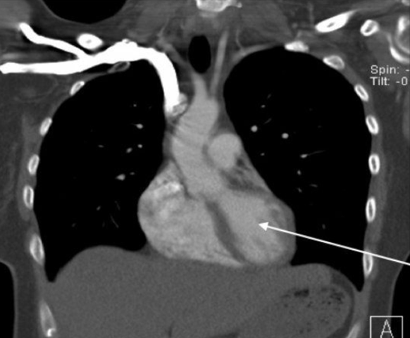 Left Ventricle