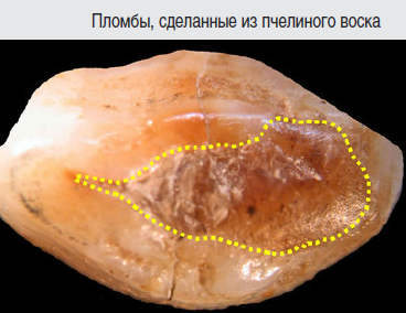 древние стоматологи