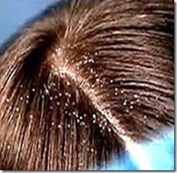 Flaky and filled with dandruff scalp treatment and cure