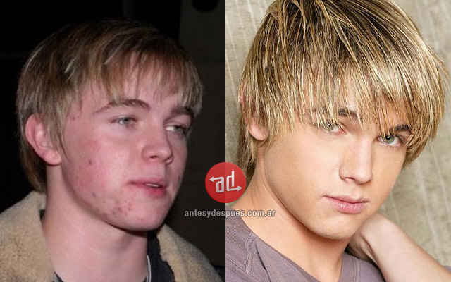 Photos of Jesse McCartney with acne